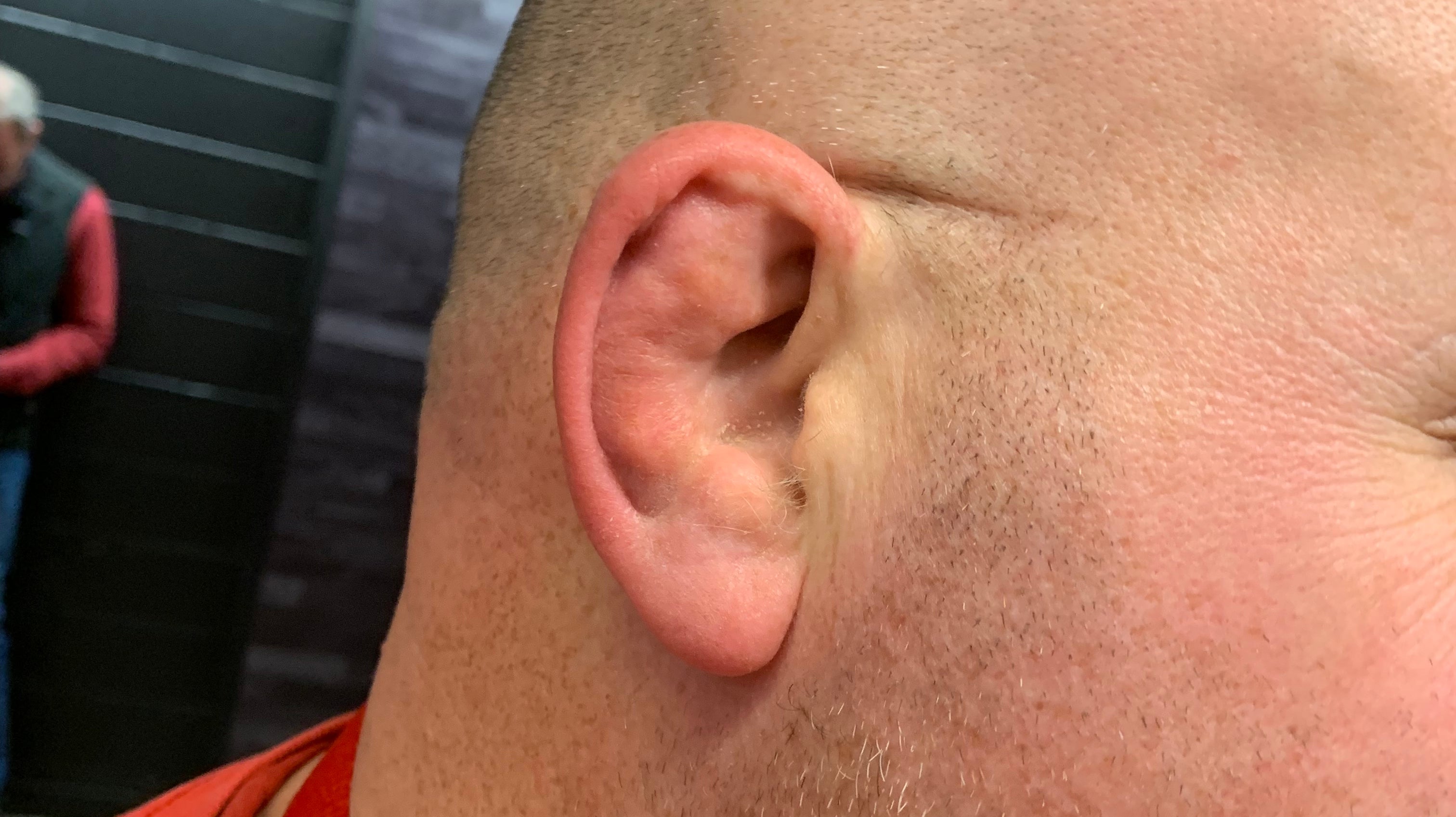 cauliflower ear bjj