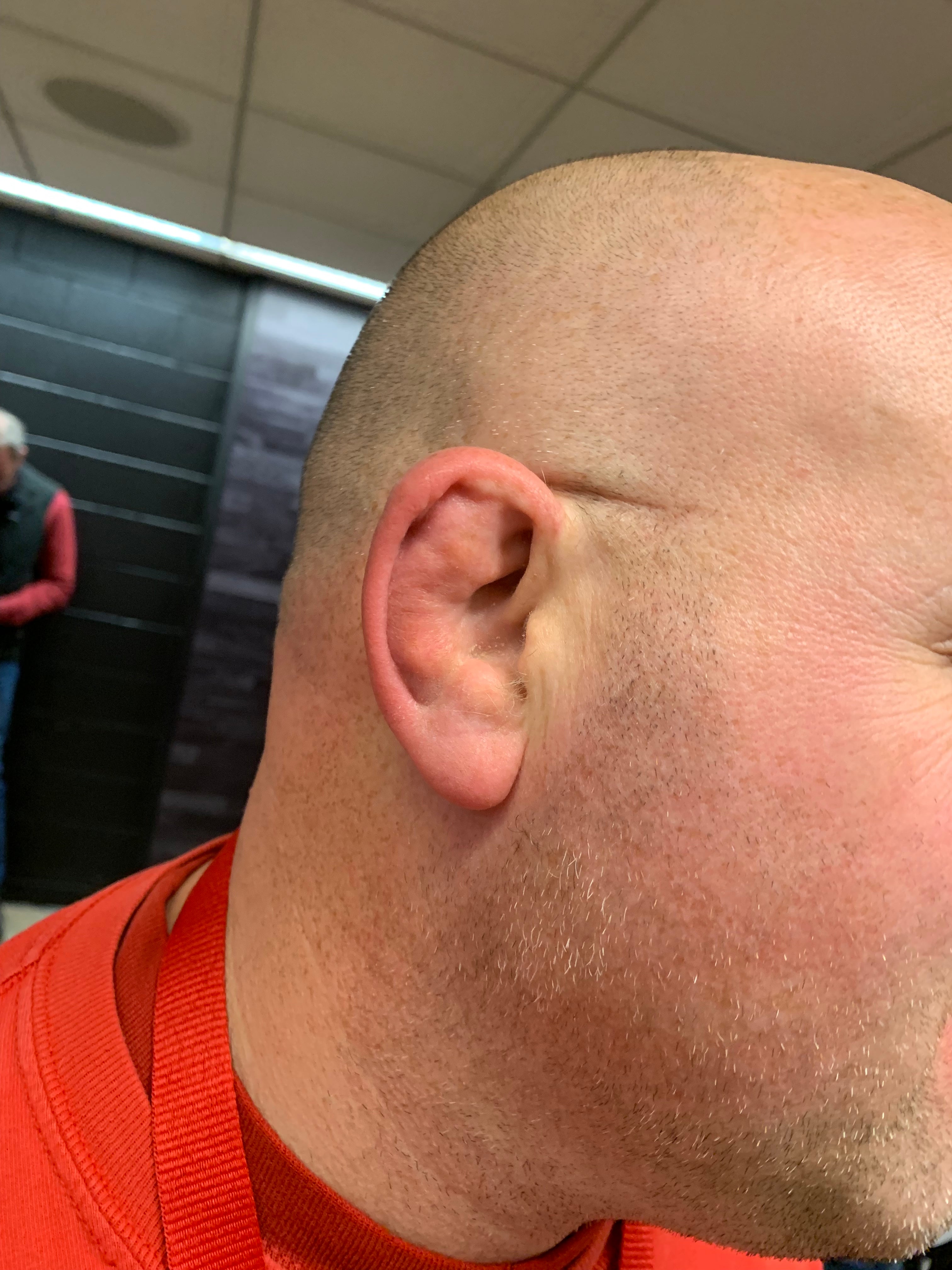 cauliflower ear bjj